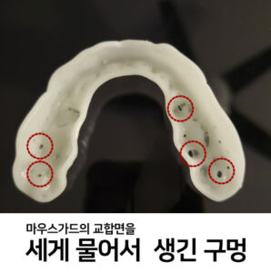 복싱 마우스피스 성형 중 세게 물어 교합면에 구멍이 생긴 사례